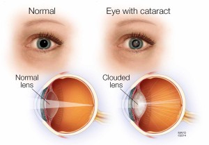 cataract info graph